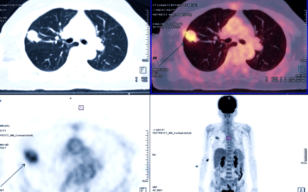After identifying eligible patients, hospitals collect clinical data and images, such as PET scans. (Credit: AdobeStock)