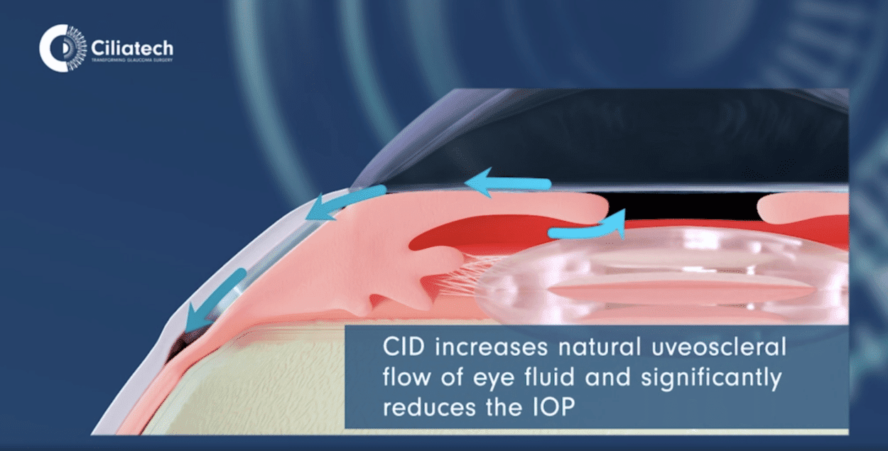 ciliatech-glaucoma-device-image-1-1250x635-1