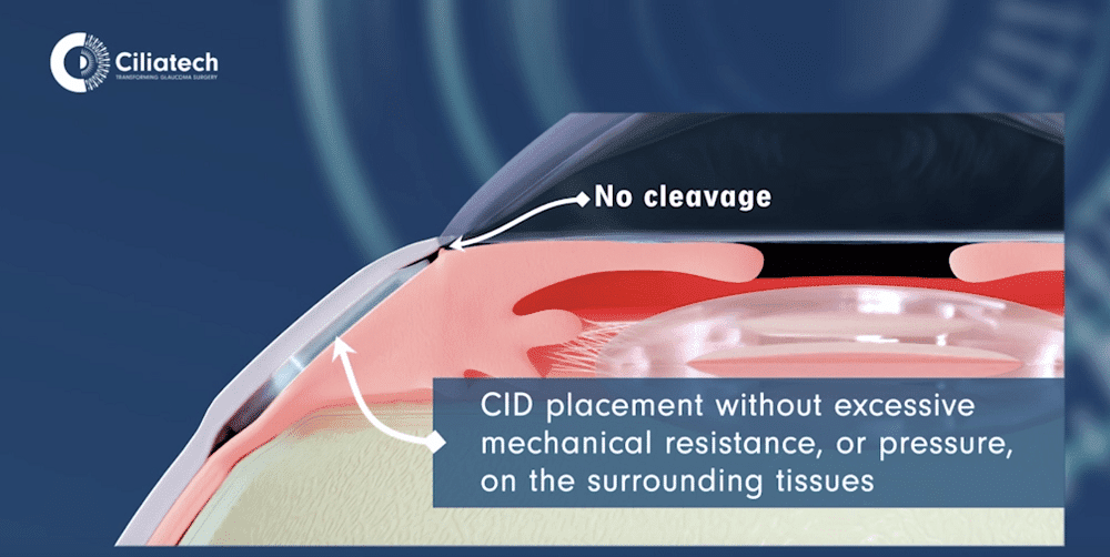 ciliatech-glaucoma-device-image-2