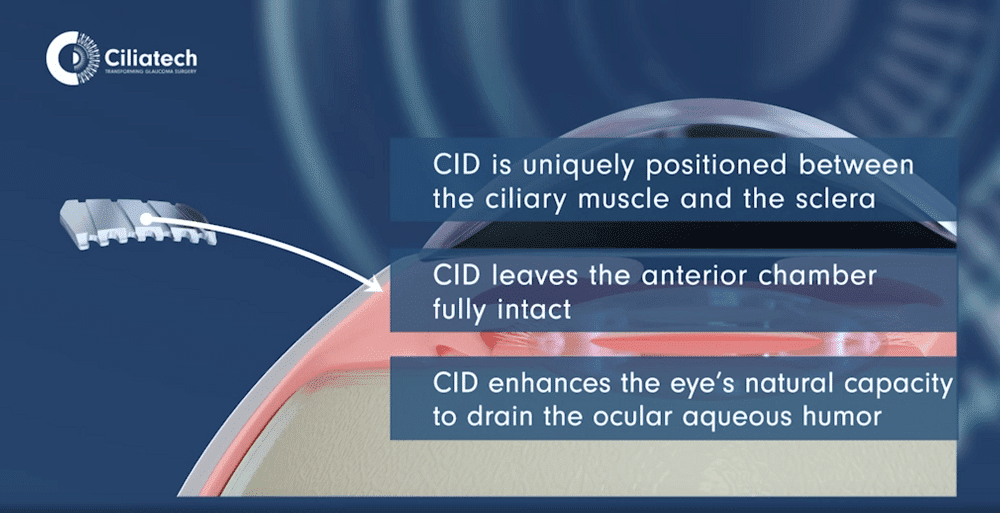 ciliatech-glaucoma-device-image-3