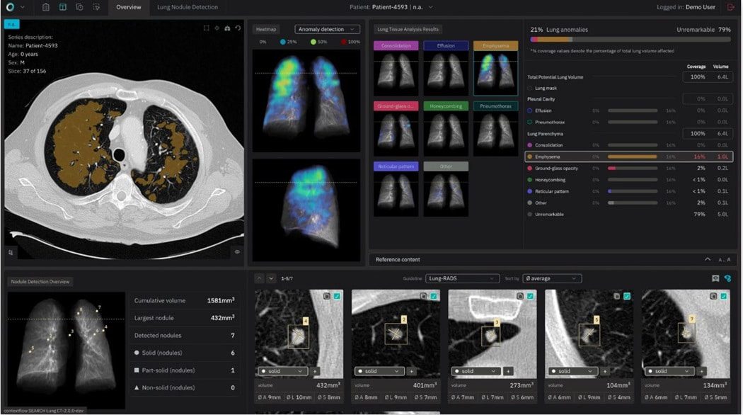 contextflow contextflow ADVANCE Chest CT - Timeline Nodule. (Credit: contextflow)