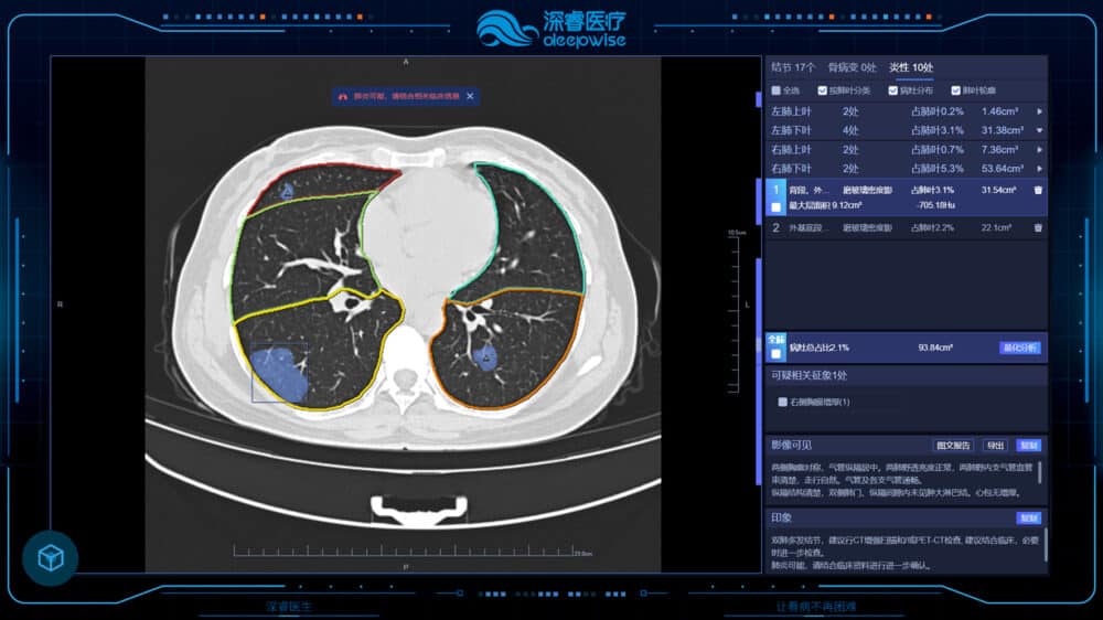The Dr. Wise system is a multi-sign and multi-disease AI solution based on chest CT. It supports one-stop automatic analysis of lung disease and the management of diagnosis and treatment. Courtesy of Deepwise.