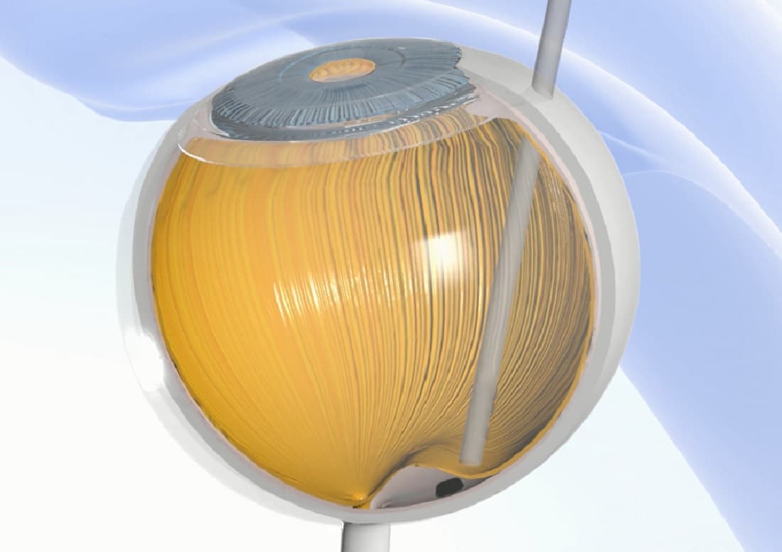 The Prima Implant Gives Hope of Sight Restoration to the Partially Blind Patients 