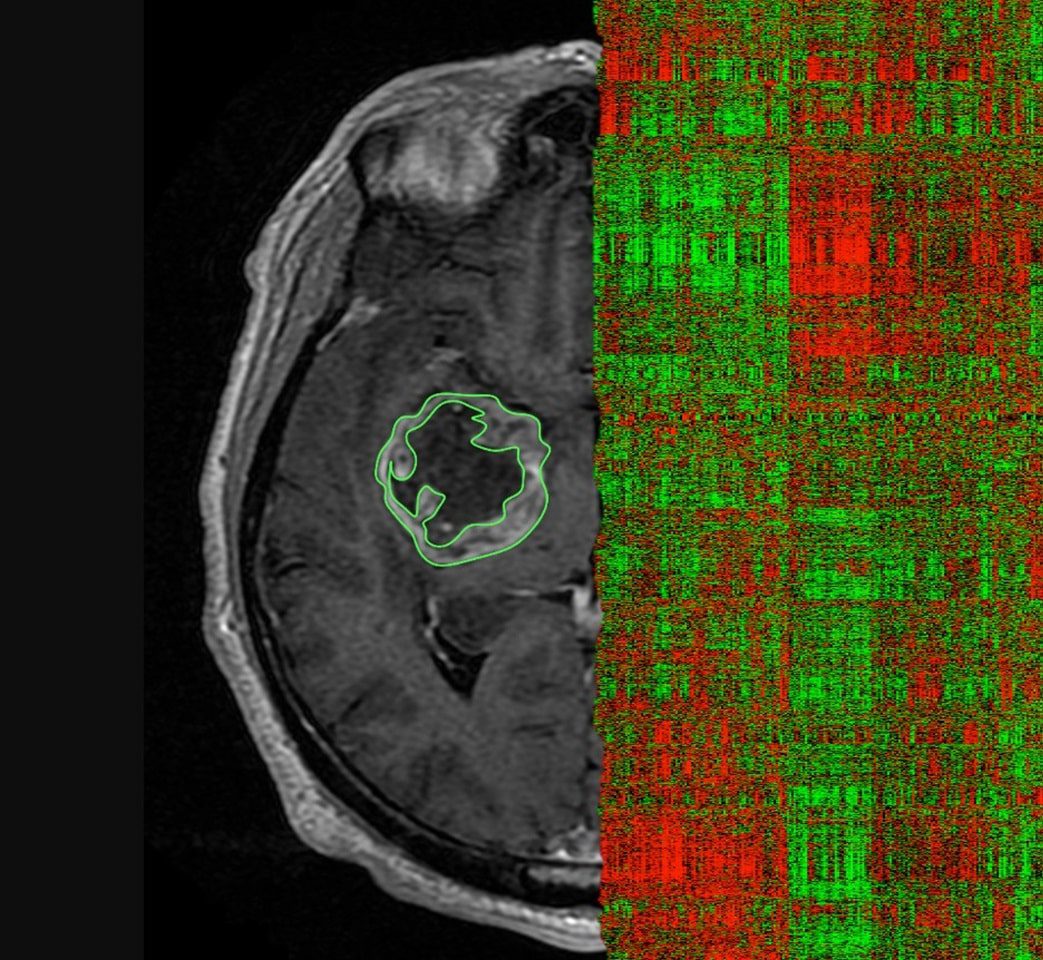 radiomics (Credit: Review on Radiomics for Brain Tumors)