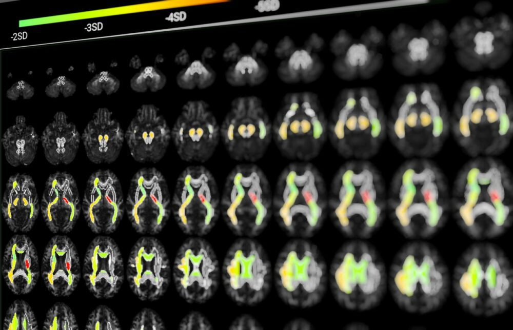 thumbnail_16-report-capture1-1000x644-1 Report. Courtesy of BrainTale.