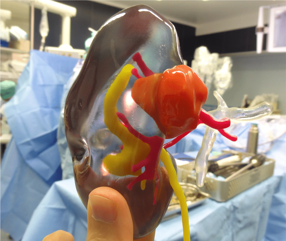 using-transparent-material-enables-surgeons-to-see-inside-the-kidney-and-estimate-the-specific-location-and-depth-at-which-the-tumor-resides Stratasys’ PolyJet-based 3D printing technology is also used for pre-surgery planning in other hospitals, including the CHU de Bordeaux, ahead of kidney cancer surgery. By using transparent material, surgeons can see inside the kidney and estimate the specific location and depth at which the tumor resides. (Credit: CHU de Bordeaux)