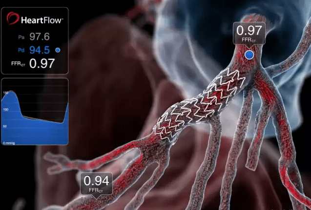 x0000_heartflow_ffrct-2-with-stent (Credit: HeartFlow)