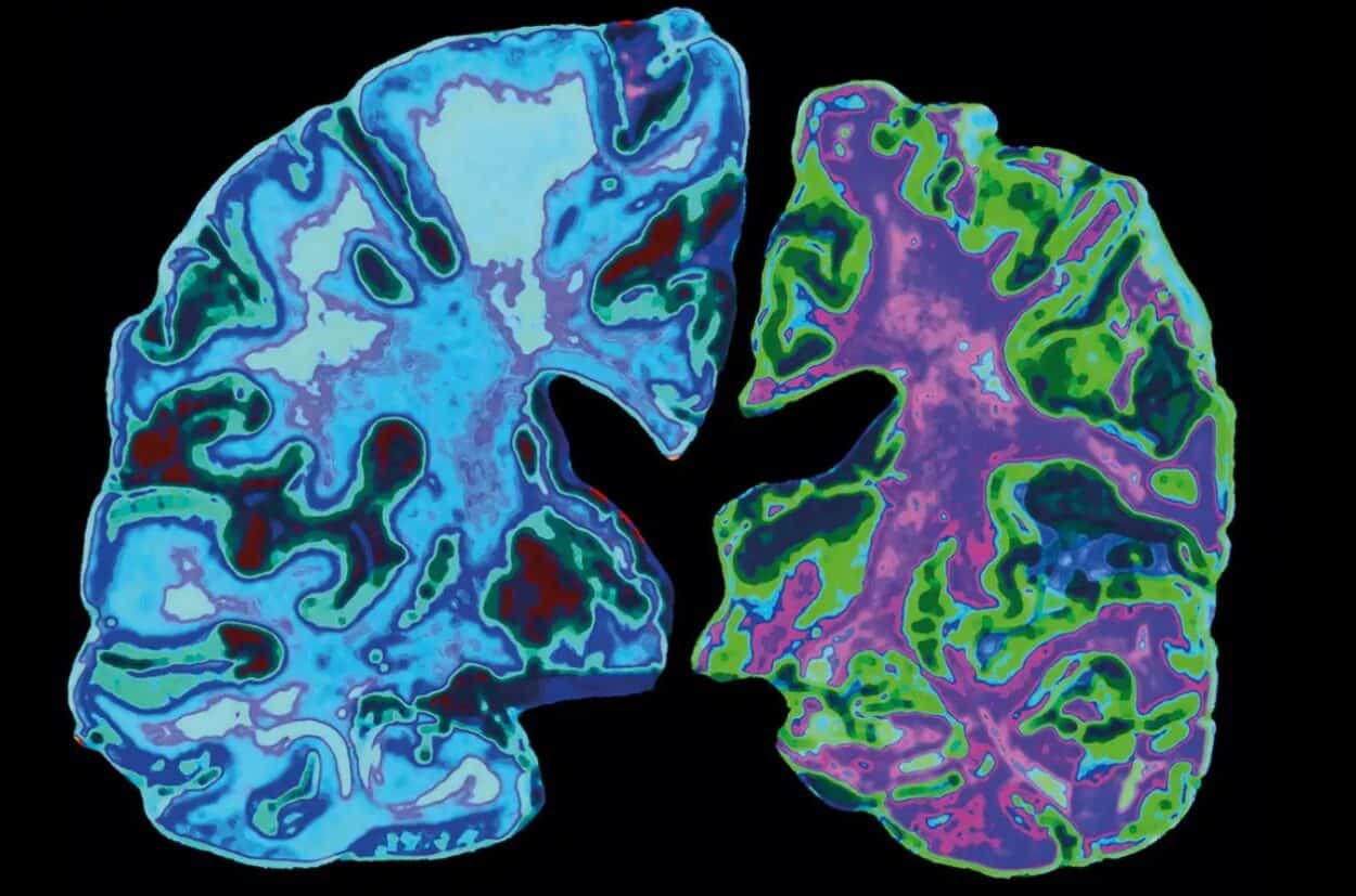 alzheimers-disease-1250x827-1 Alzheimer’s disease has destroyed neurons in the right-hand brain. (Credit: Jessica Wilson/Science Photo Library)