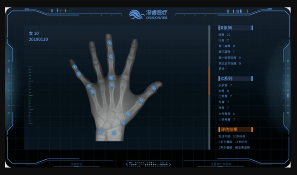 The system adopts deep learning and TW3 standard to develop an accurate, efficient bone age assessment model. The system can identify automatically epiphysis to calculate bone age and make the classification. The graphic report can be automatically generated to help radiologists to improve efficiency and to avoid artificial errors. Courtesy of Deepwise.