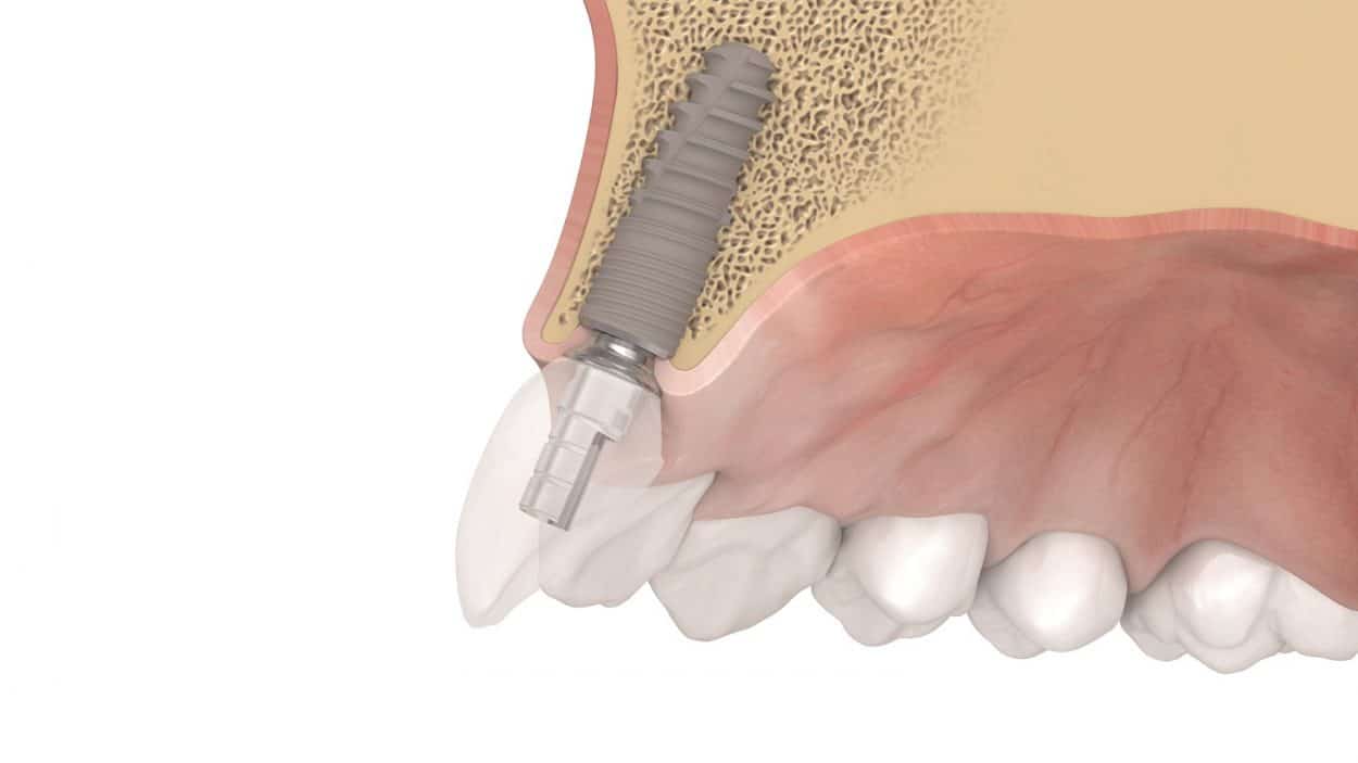 dentaurum-tiologic-twinfit-1250x703-1 Dentaurum's tioLogic TWINFIT (Credit: Dentaurum)