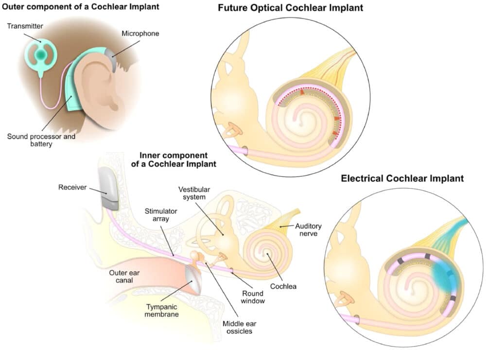 gr1_lrg1-1000x720-1 Courtesy of The Lancet