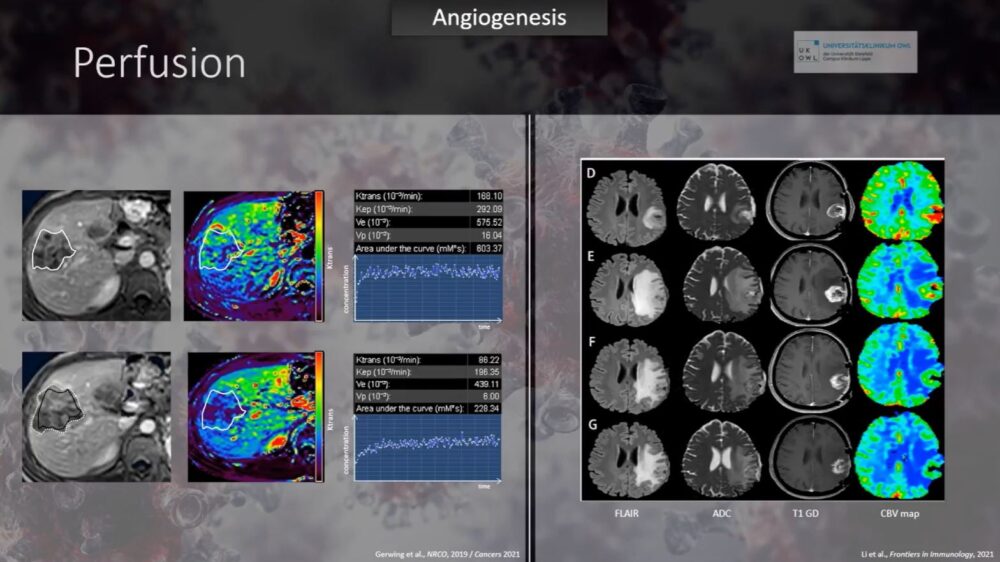 imaging-answers-to-immunotherapy-demands-esr-connect-8-1000x562-1 Screenshot of presentation during the event. Courtesy of the panelist and ECR.