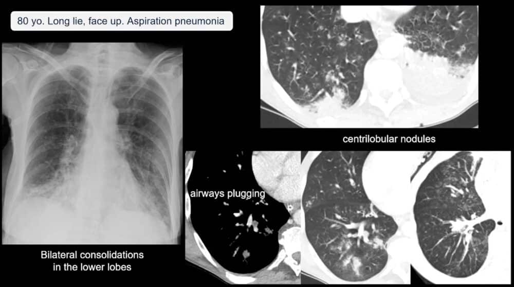 low-to-high-impact_-principles-in-whole-body-imaging-esr-connect-8-1000x558-1 Screenshot of presentation. Courtesy of the panelist and ECR.