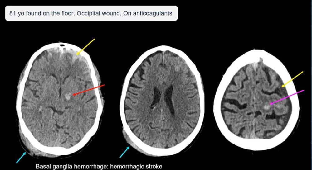 low-to-high-impact_-principles-in-whole-body-imaging-esr-connect-9-1000x546-1 Screenshot of presentation. Courtesy of the panelist and ECR.