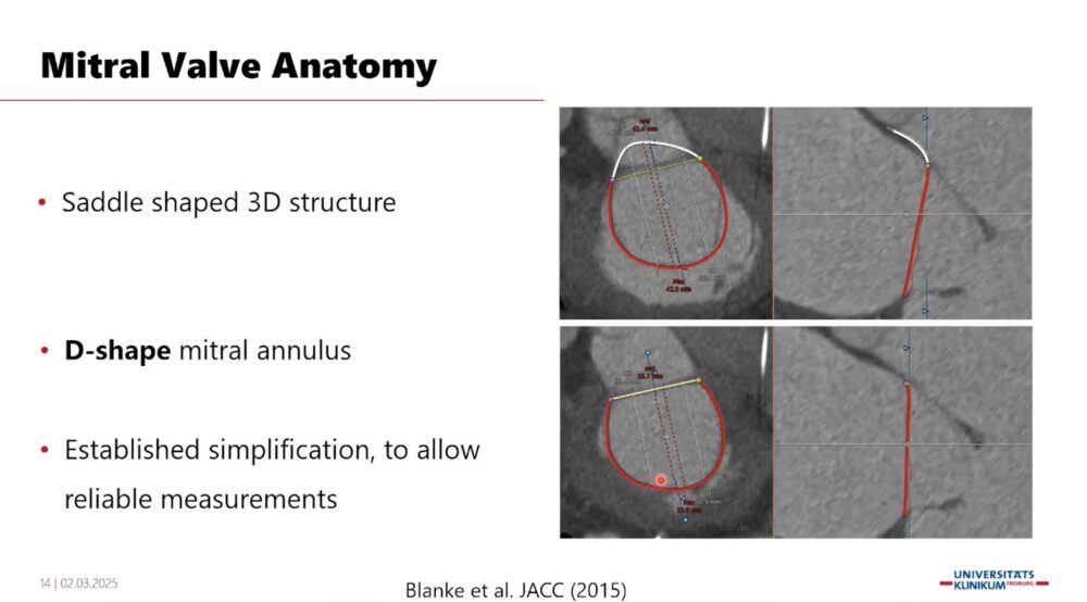 measuring-the-heart_-a-radiologist-with-a-ruler-esr-connect-16-1000x554-1 Screenshot of the presentation. Courtesy of the speaker and ECR.