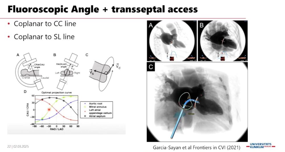 measuring-the-heart_-a-radiologist-with-a-ruler-esr-connect-19-1000x534-1 Screenshot of the presentation. Courtesy of the speaker and ECR.