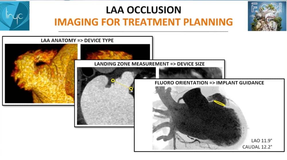 measuring-the-heart_-a-radiologist-with-a-ruler-esr-connect-23-1000x559-1 Screenshot of the presentation. Courtesy of the speaker and ECR.