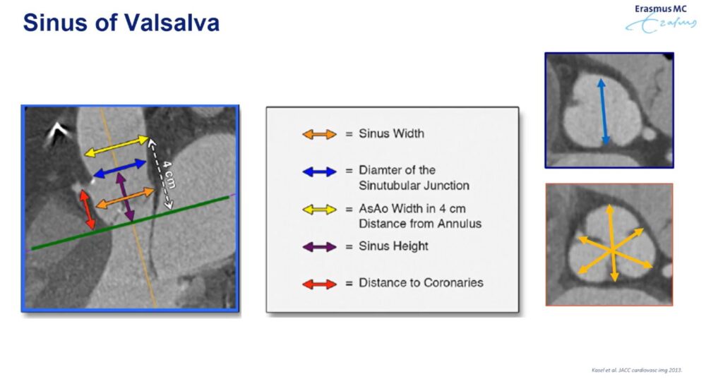 measuring-the-heart_-a-radiologist-with-a-ruler-esr-connect-9-1000x537-1 Screenshot of the presentation. Courtesy of the speaker and ECR.