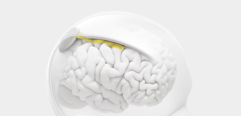 precision-neuro-1000x483-1 Courtesy of Precision Neuro