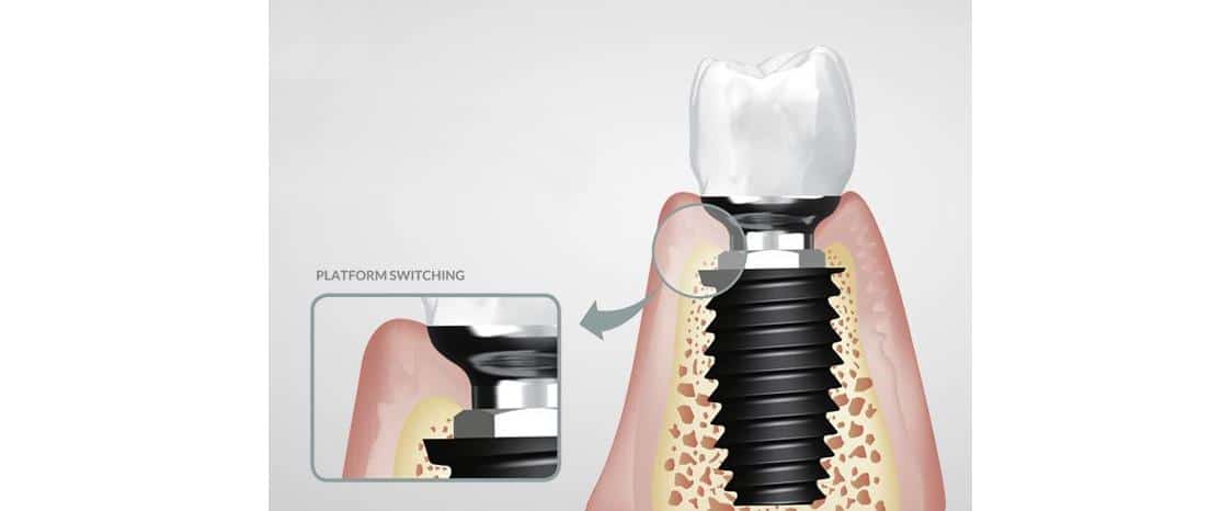 slock-impant-kdi The Korea Dental Implant (KDI) Inc presented its SLOCK implant system. (Credit KDI)