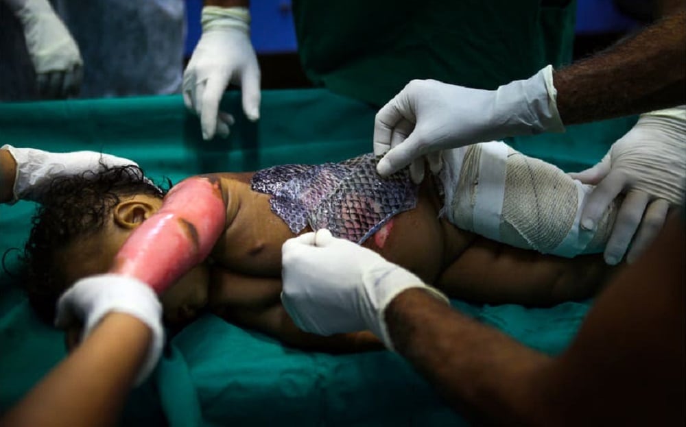 Doctors Turn to the Natural World to Help Cure Skin Wounds